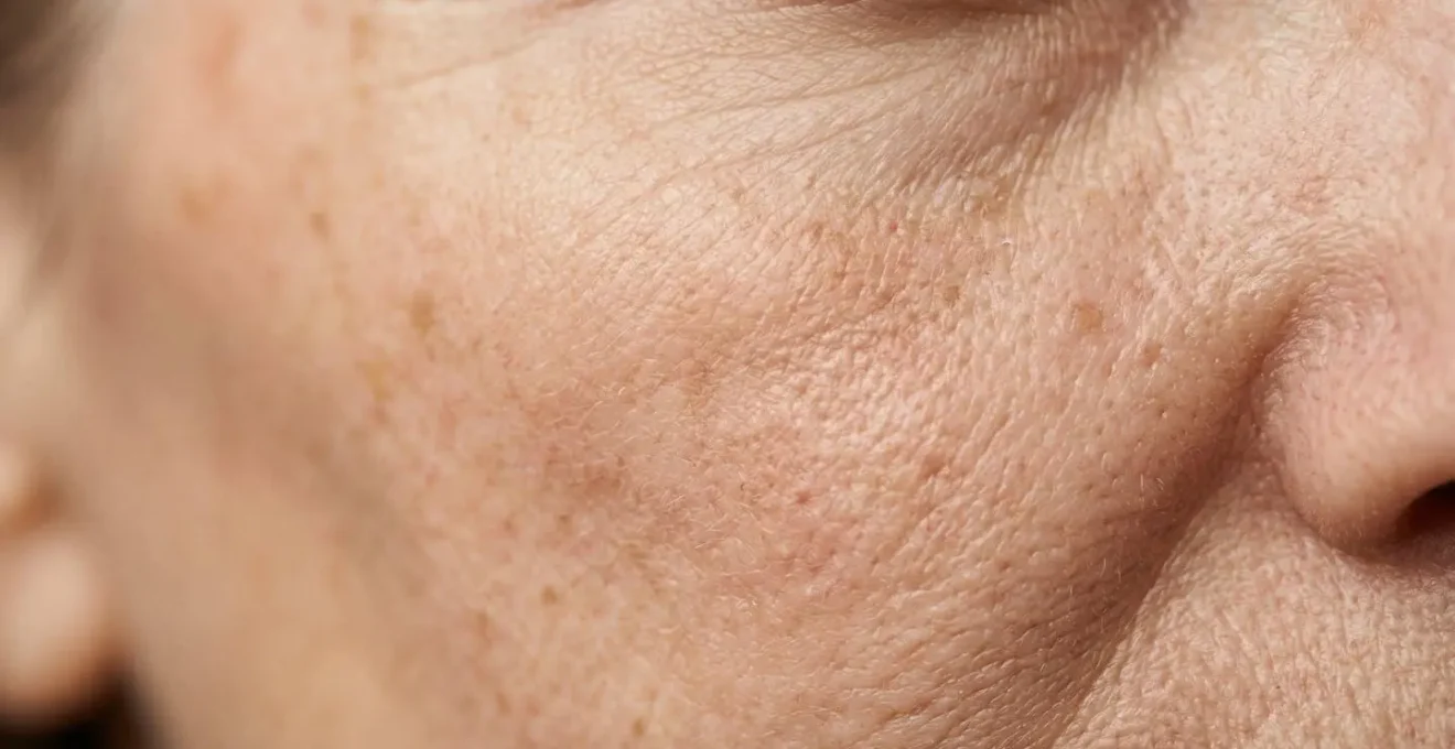 Primo piano di pelle trattata con tecnologia laser per il ringiovanimento cutaneo e la riparazione dei danni solari